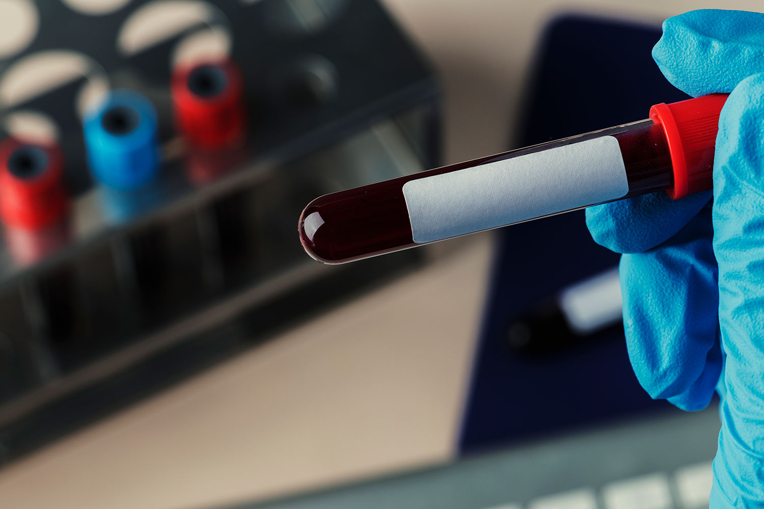 Oxford desarrolla un test de sangre con el que se puede detectar el párkinson antes de la aparición de los síntomas