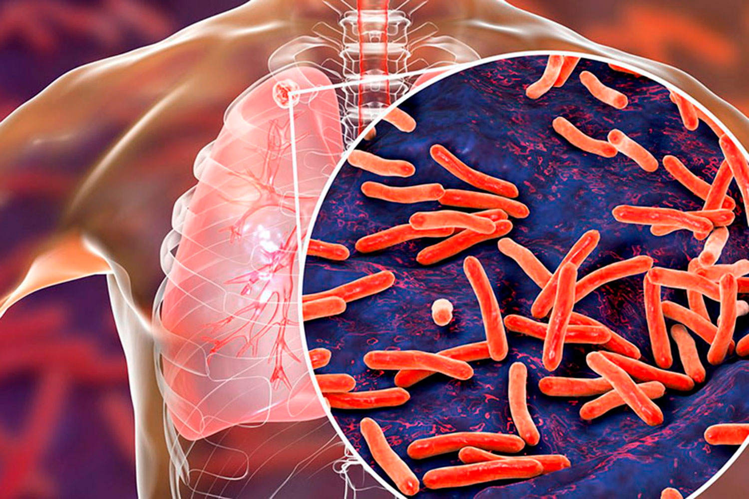 La Tuberculosis - TB
